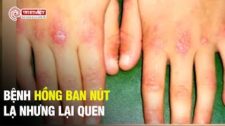 Bệnh hồng ban đa dạng kiêng ăn gì