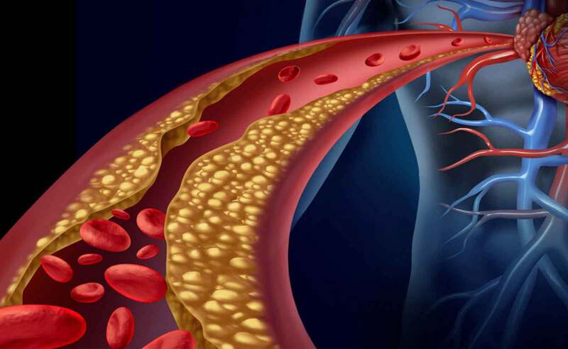 Bệnh rối loạn lipid máu là gì