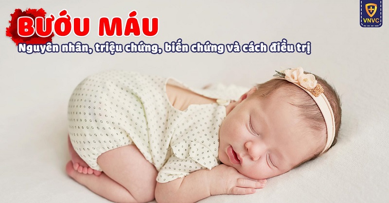 Bướu máu là gì