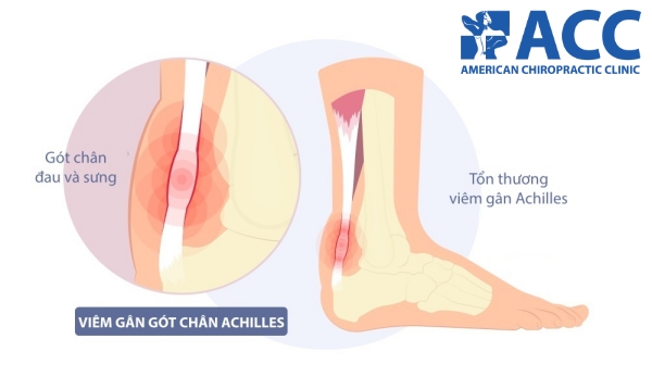 đau gân gót chân là bệnh gì