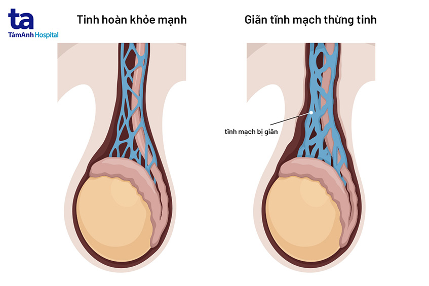 Giãn tĩnh mạch tinh là gì