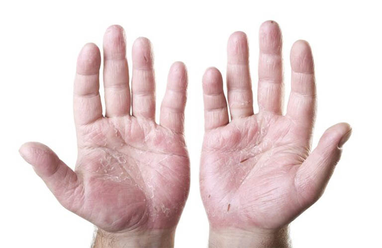 Lòng bàn tay khô là bệnh gì