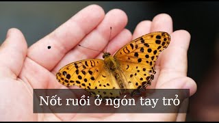 Nốt ruồi trên ngón tay trỏ