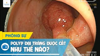 Polyp truc trang la gi