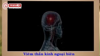 Viêm thần kinh ngoại biên là gì